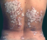 寻常型牛皮癣